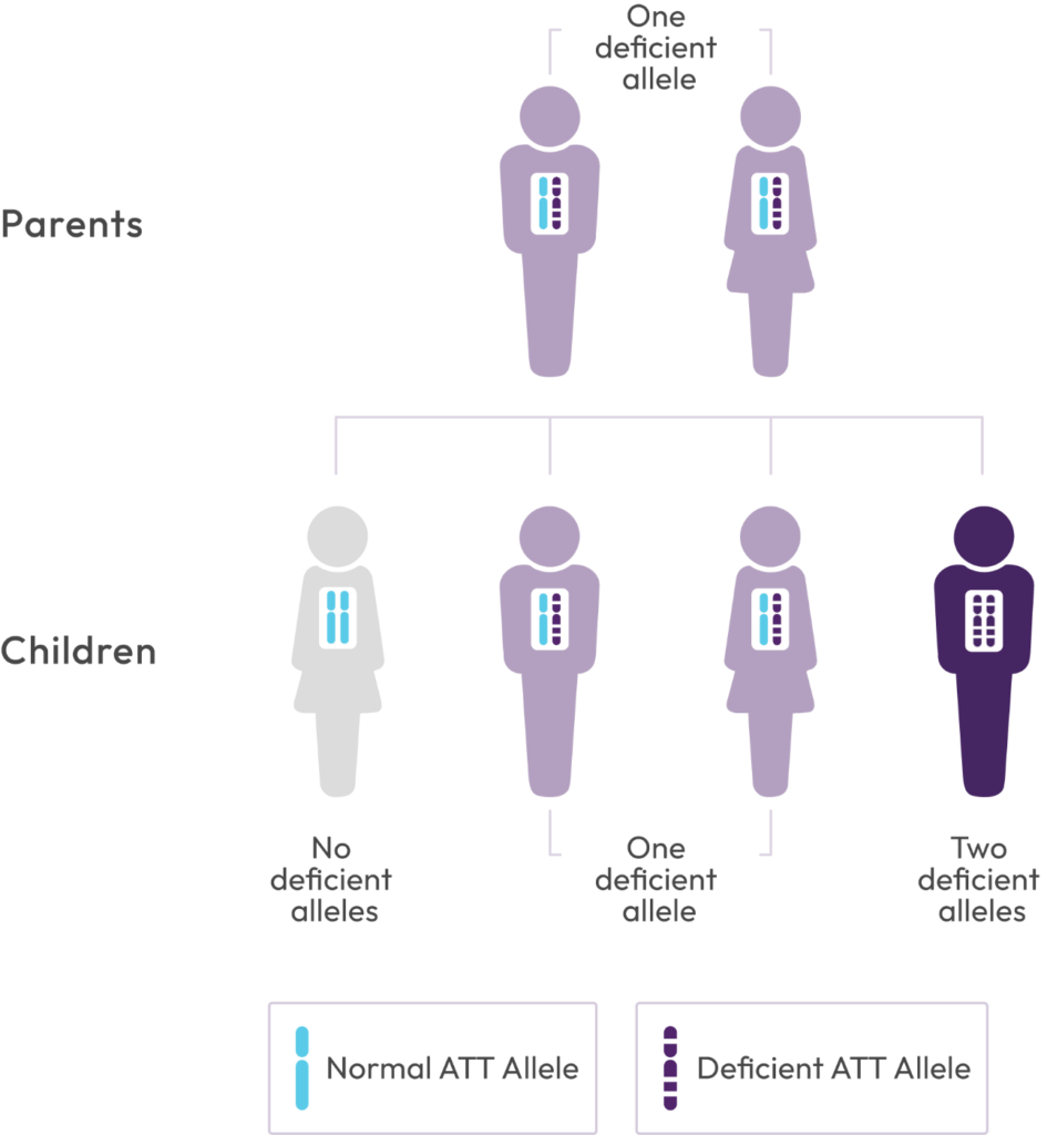 Family inheritance diagram. Two parents each carry one deficient AAT allele. Their children may inherit no deficient alleles, one deficient allele, or two deficient alleles. A key distinguishes a normal AAT allele from a deficient AAT allele.